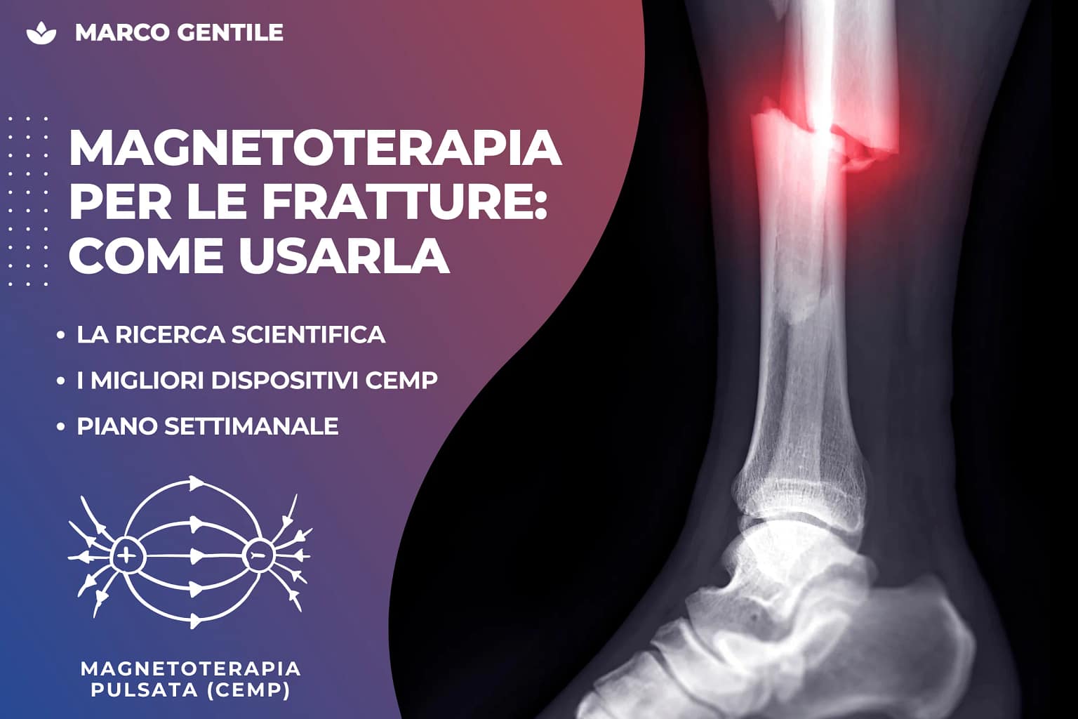 Magnetoterapia Fratture